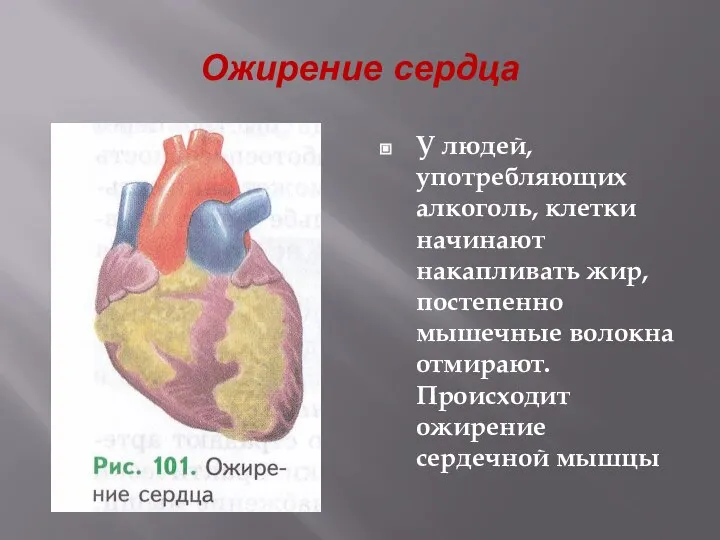 Ожирение сердца У людей, употребляющих алкоголь, клетки начинают накапливать жир, постепенно мышечные