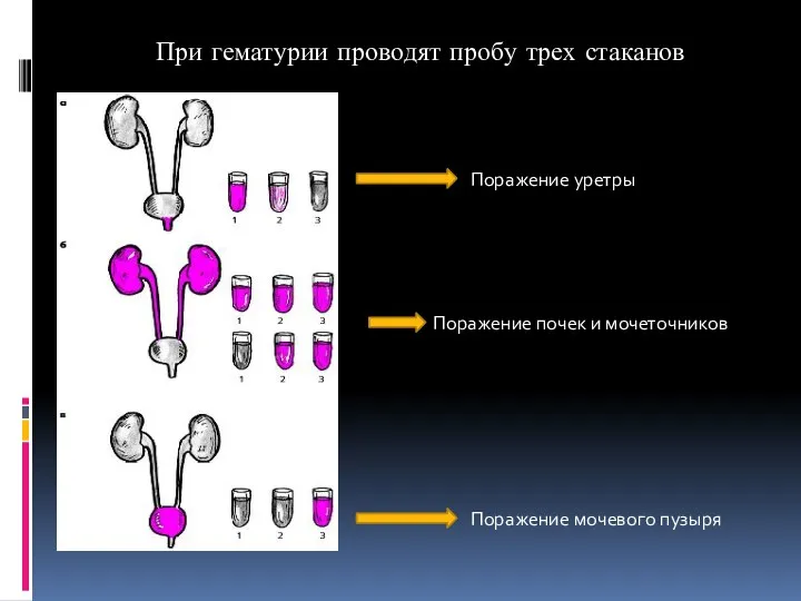 При гематурии проводят пробу трех стаканов Поражение уретры Поражение почек и мочеточников Поражение мочевого пузыря