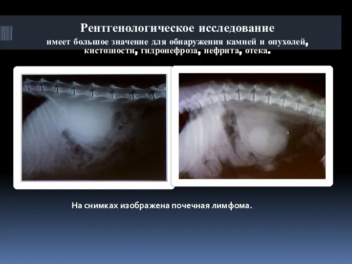 На снимках изображена почечная лимфома. Рентгенологическое исследование имеет большое значение для обнаружения