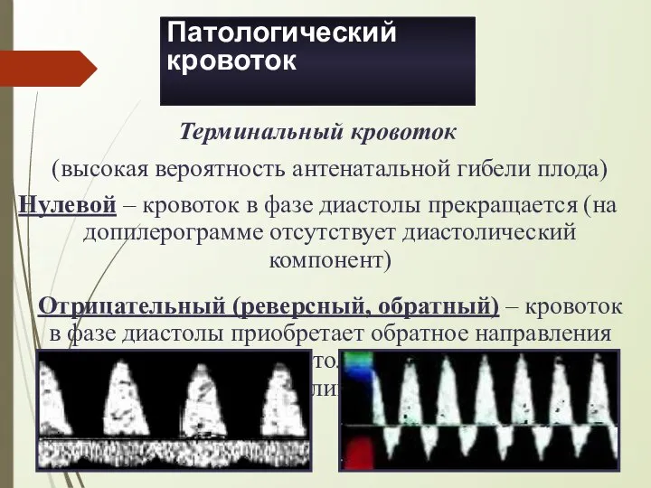 Патологический кровоток Терминальный кровоток (высокая вероятность антенатальной гибели плода) Нулевой – кровоток