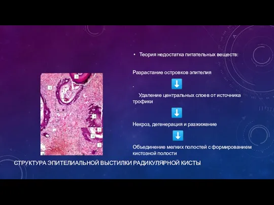 СТРУКТУРА ЭПИТЕЛИАЛЬНОЙ ВЫСТИЛКИ РАДИКУЛЯРНОЙ КИСТЫ Теория недостатка питательных веществ: Разрастание островков эпителия