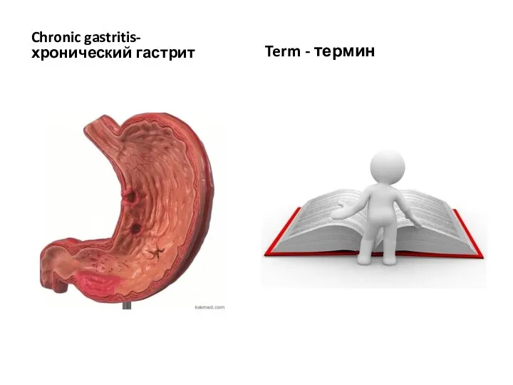 Chronic gastritis- хронический гастрит Term - термин