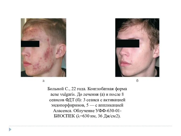 Больной С., 22 года. Конглобатная форма acne vulgaris. До лечения (а) и