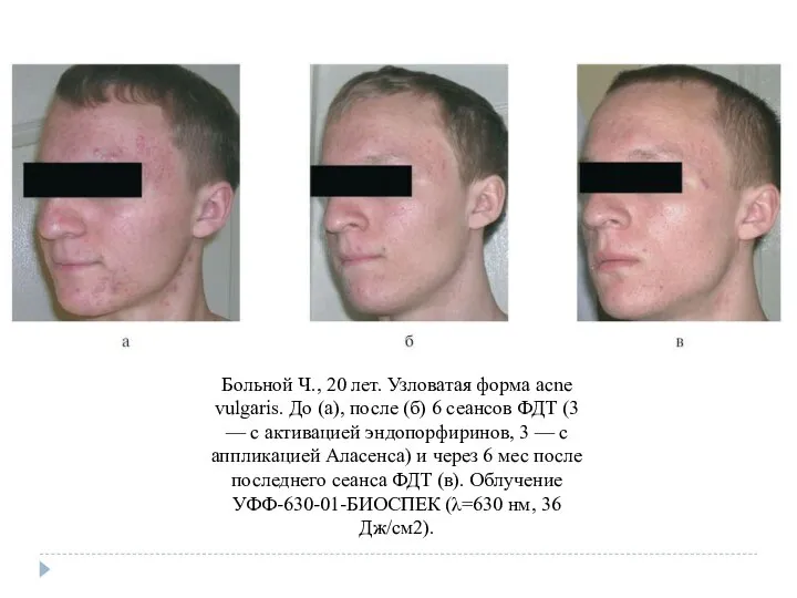 Больной Ч., 20 лет. Узловатая форма acne vulgaris. До (а), после (б)