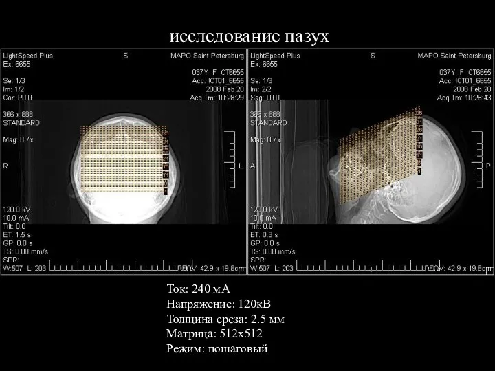 исследование пазух Ток: 240 мА Напряжение: 120кВ Толщина среза: 2.5 мм Матрица: 512х512 Режим: пошаговый