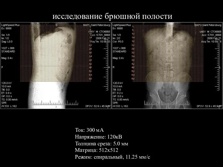 исследование брюшной полости Ток: 300 мА Напряжение: 120кВ Толщина среза: 5.0 мм