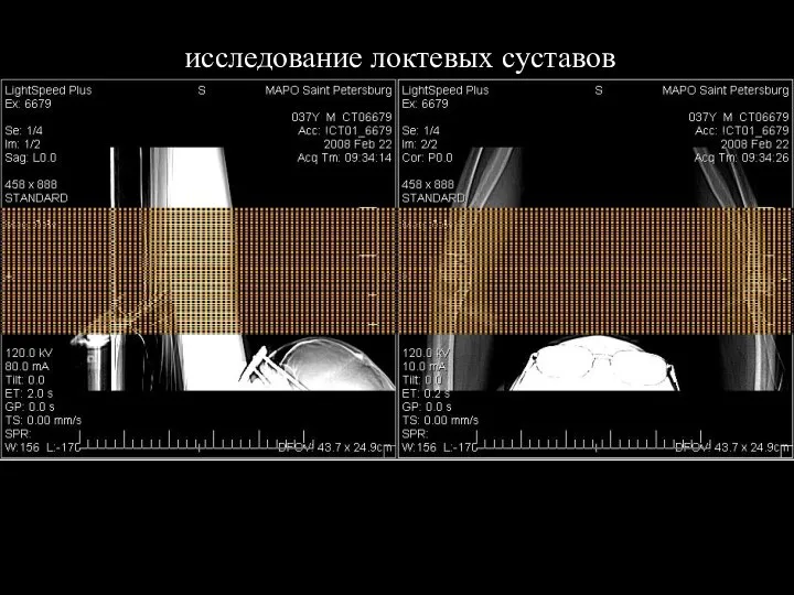 исследование локтевых суставов