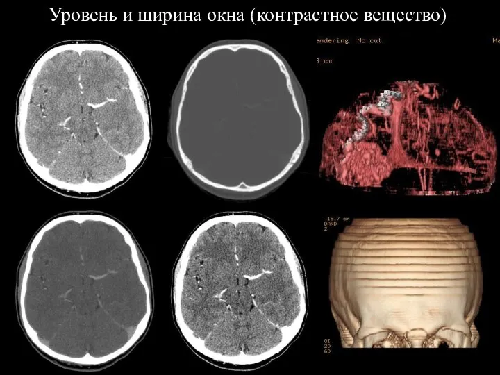 Уровень и ширина окна (контрастное вещество)