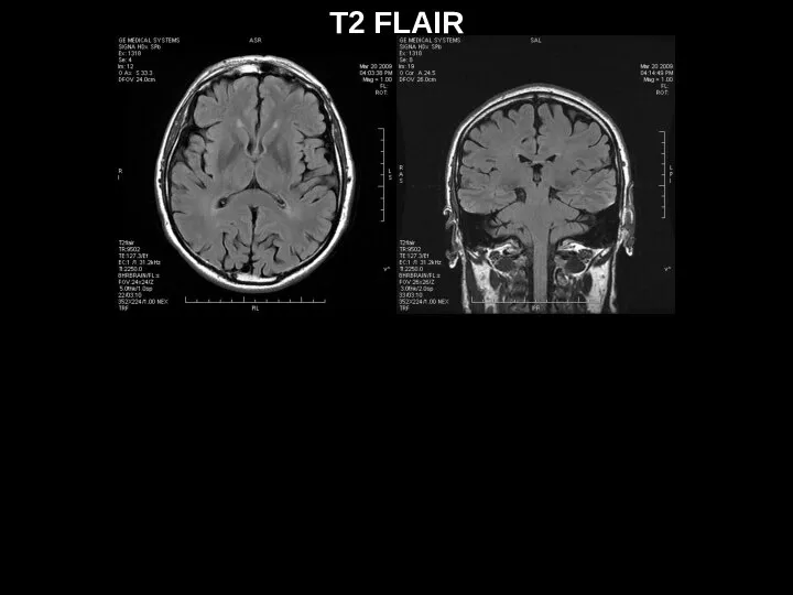 T2 FLAIR