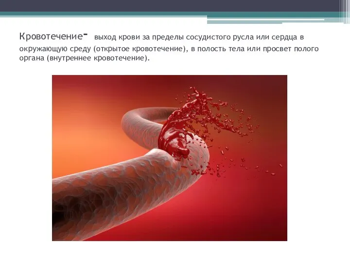 Кровотечение- выход крови за пределы сосудистого русла или сердца в окружающую среду