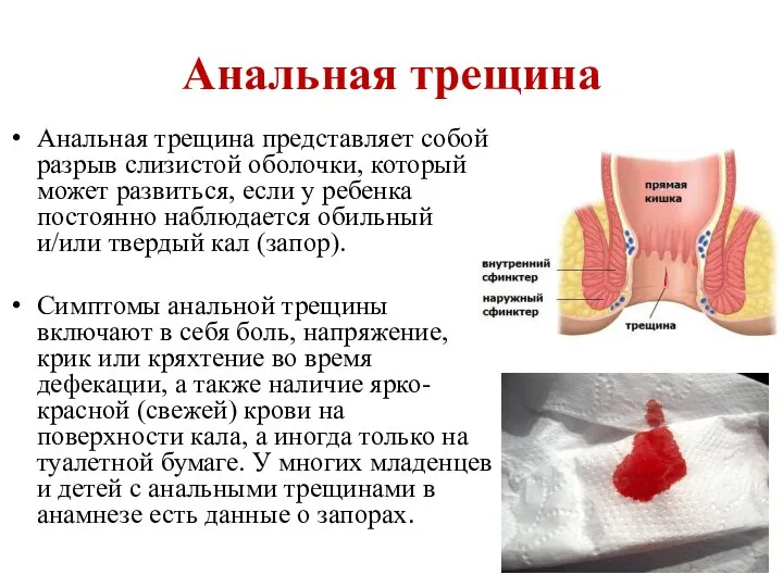 Анальная трещина Анальная трещина представляет собой разрыв слизистой оболочки, который может развиться,