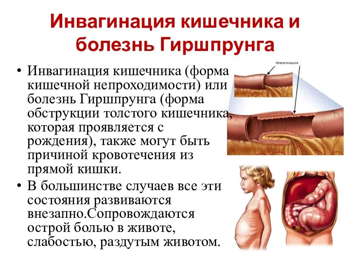 Инвагинация кишечника и болезнь Гиршпрунга Инвагинация кишечника (форма кишечной непроходимости) или болезнь