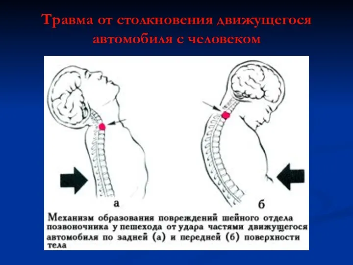 Травма от столкновения движущегося автомобиля с человеком