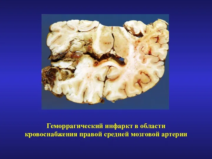 Геморрагический инфаркт в области кровоснабжения правой средней мозговой артерии