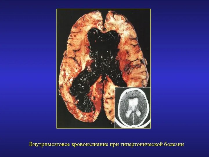 Внутримозговое кровоизлияние при гипертонической болезни