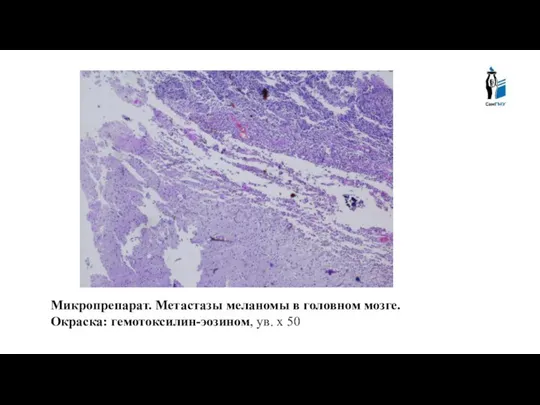 Микропрепарат. Метастазы меланомы в головном мозге. Окраска: гемотоксилин-эозином, ув. х 50