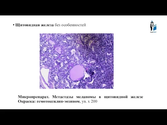 Щитовидная железа без особенностей Микропрепарат. Метастазы меланомы в щитовидной железе Окраска: гемотоксилин-эозином, ув. х 200