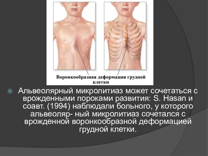 Альвеолярный микролитиаз может сочетаться с врожденными пороками развития: S. Hasan и соавт.