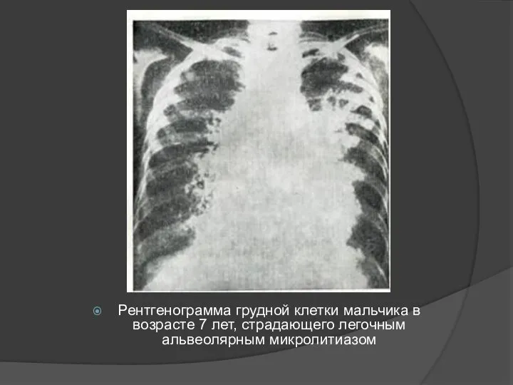 Рентгенограмма грудной клетки мальчика в возрасте 7 лет, страдающего легочным альвеолярным микролитиазом