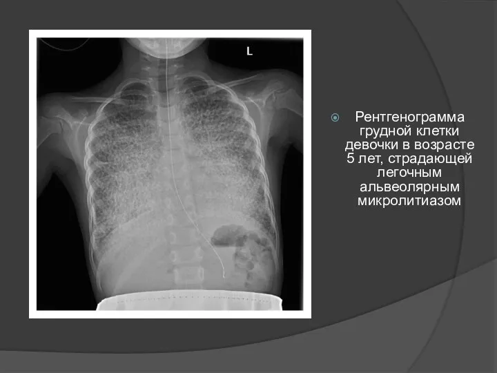 Рентгенограмма грудной клетки девочки в возрасте 5 лет, страдающей легочным альвеолярным микролитиазом