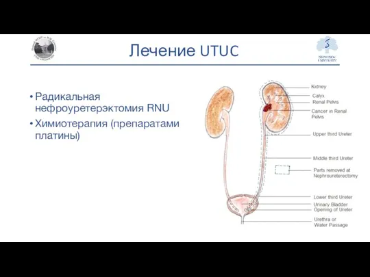 Лечение UTUC Радикальная нефроуретерэктомия RNU Химиотерапия (препаратами платины)