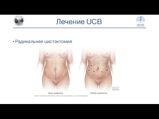 Лечение UCB Радикальная цистэктомия