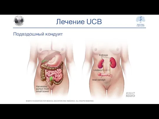 Лечение UCB Подвздошный кондуит