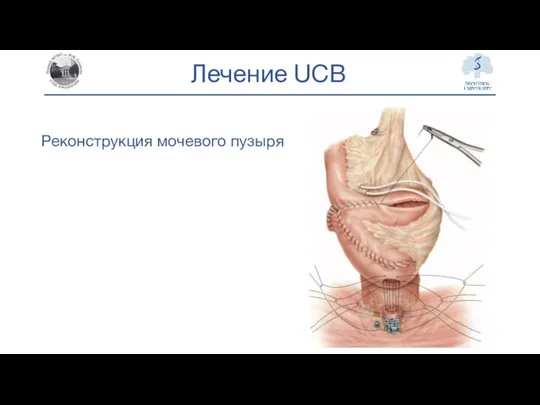 Лечение UCB Реконструкция мочевого пузыря