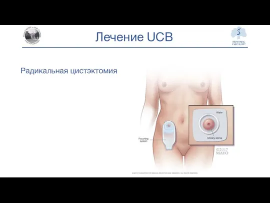 Лечение UCB Радикальная цистэктомия