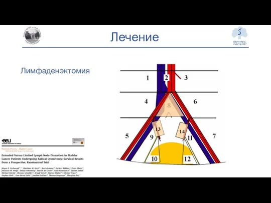 Лечение Лимфаденэктомия