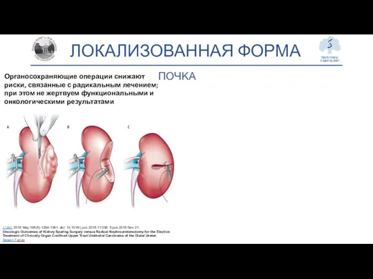 ЛОКАЛИЗОВАННАЯ ФОРМА ПОЧКА Органосохраняющие операции снижают риски, связанные с радикальным лечением; при