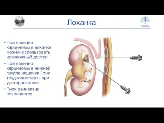 Лоханка При наличии карциномы в лоханке, можем использовать чрезкожный доступ При наличии