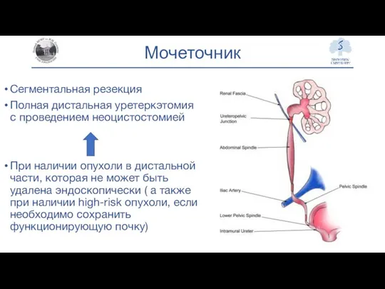 Мочеточник Сегментальная резекция Полная дистальная уретеркэтомия с проведением неоцистостомией При наличии опухоли