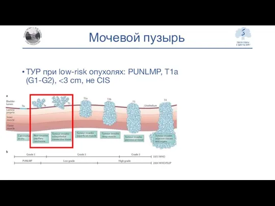 Мочевой пузырь ТУР при low-risk опухолях: PUNLMP, T1a (G1-G2),