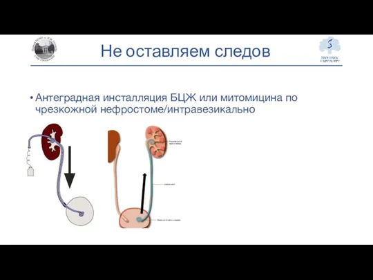 Не оставляем следов Антеградная инсталляция БЦЖ или митомицина по чрезкожной нефростоме/интравезикально