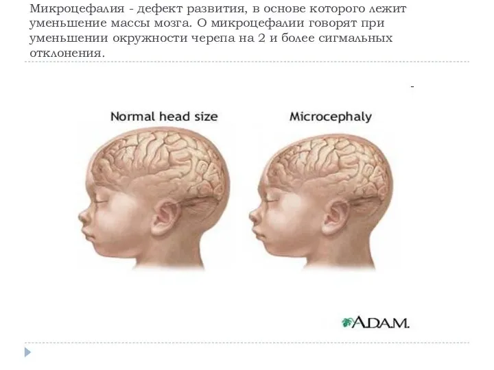 Микроцефалия - дефект развития, в основе которого лежит уменьшение массы мозга. О