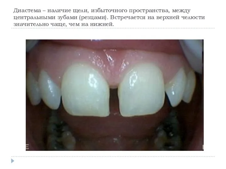 Диастема – наличие щели, избыточного пространства, между центральными зубами (резцами). Встречается на