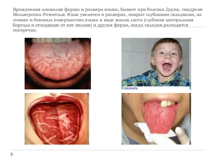 Врожденная аномалия формы и размера языка, бывает при болезни Дауна, синдроме Мелькерсона-Розенталя.