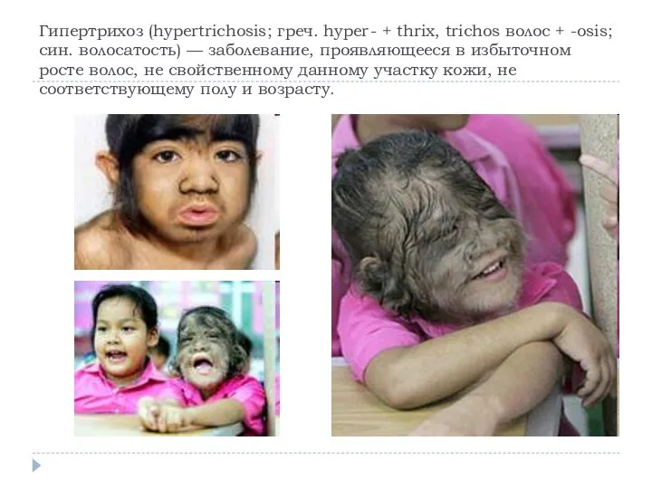Гипертрихоз (hypertrichosis; греч. hyper- + thrix, trichos волос + -osis; син. волосатость)