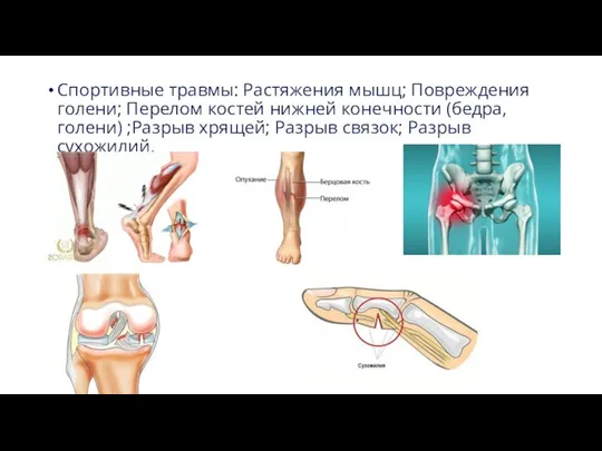 Спортивные травмы: Растяжения мышц; Повреждения голени; Перелом костей нижней конечности (бедра, голени)