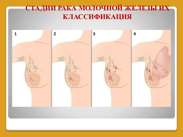 СТАДИИ РАКА МОЛОЧНОЙ ЖЕЛЕЗЫ ИХ КЛАССИФИКАЦИЯ