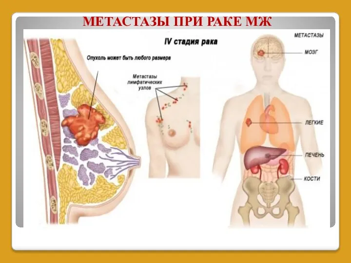 МЕТАСТАЗЫ ПРИ РАКЕ МЖ