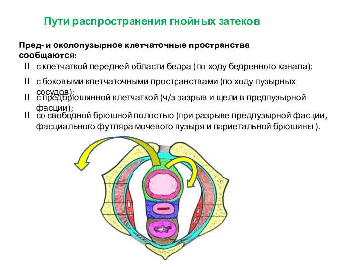 Пути распространения гнойных затеков Пред- и околопузырное клетчаточные пространства сообщаются: с клетчаткой