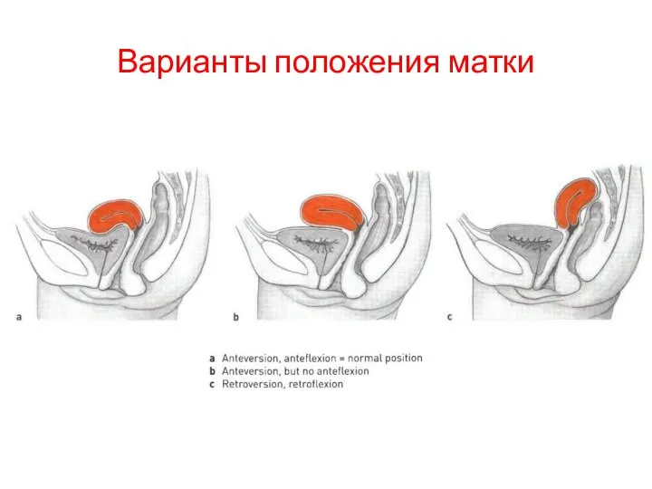 Варианты положения матки