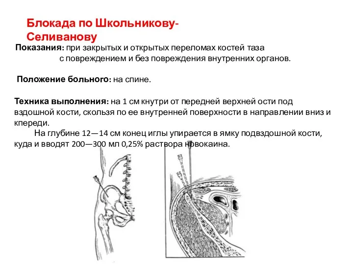 Блокада по Школьникову-Селиванову Показания: при закрытых и открытых переломах костей таза с