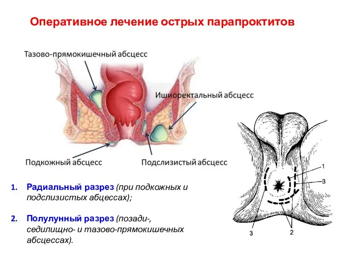 Оперативное лечение острых парапроктитов Радиальный разрез (при подкожных и подслизистых абцессах); Полулунный