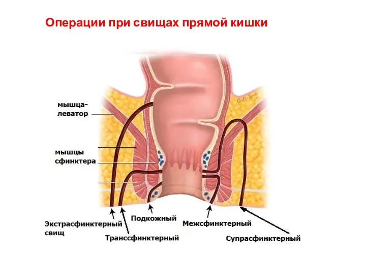 Операции при свищах прямой кишки