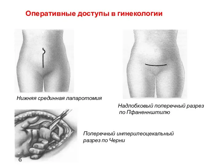 Оперативные доступы в гинекологии Нижняя срединная лапаротомия Надлобковый поперечный разрез по Пфаненнштилю