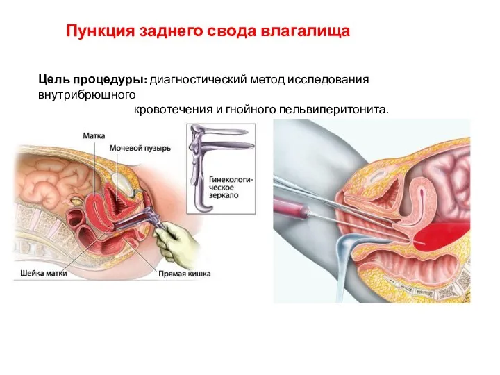 Пункция заднего свода влагалища Цель процедуры: диагностический метод исследования внутрибрюшного кровотечения и гнойного пельвиперитонита.