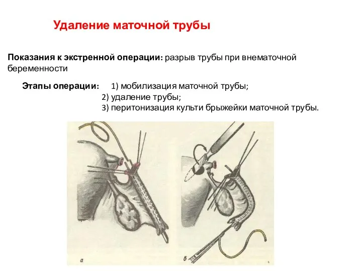 Удаление маточной трубы Показания к экстренной операции: разрыв трубы при внематочной беременности